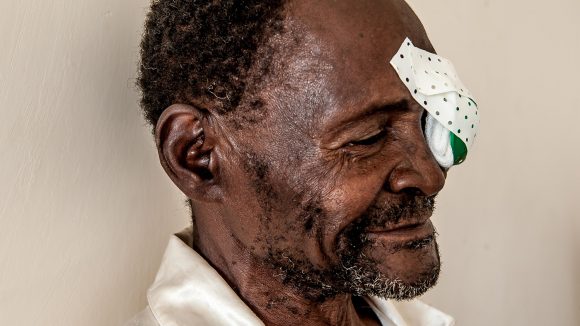 Winesi March after cataract operation with a patch over one eye.