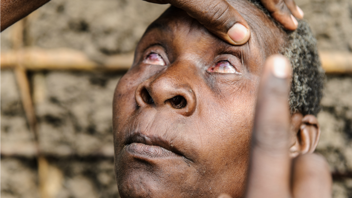 The sightsavers medical team check Aluna's eyes
