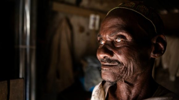 Mamodu stares into the distance. It is easy to see the cloudiness in his eyes