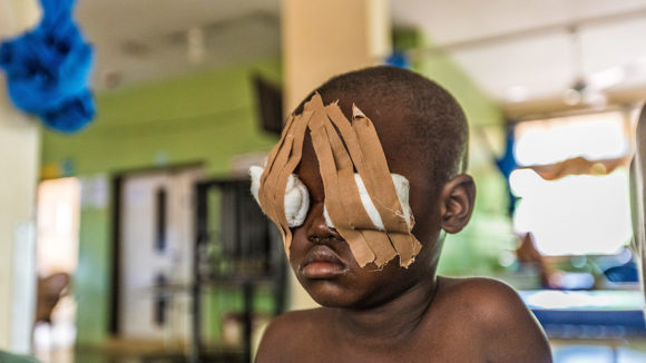 Muzi's eyes are covered with cotton wool, after a successful surgery in a hospital in Nigeria