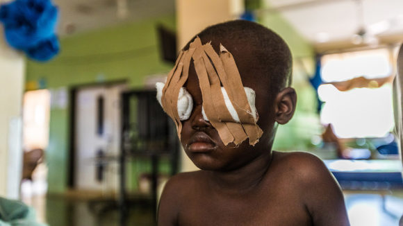 Muzii had trichiasis surgery in Nigeria