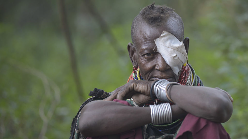 Ekeno sits with a bandage on her eye.