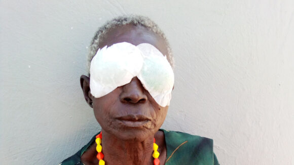 Napelekori has bandages over her eyes after her cataract operation.